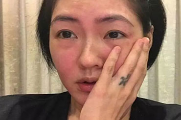 換季皮膚過敏怎么辦？六大致敏誤區!
